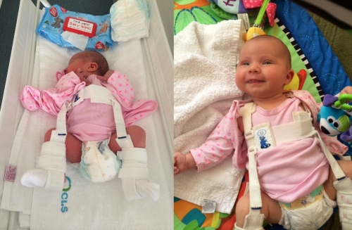 Left; 3 days old in the Pavlik Harness. Right; 7 weeks old in the Pavlik Harness